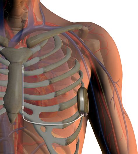 s icd implant procedure.